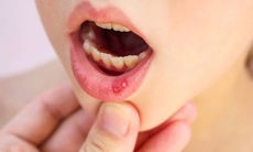 Bí quyết từ thảo dược hỗ trợ giảm nỗi lo nhiệt miệng dai dẳng mùa lạnh