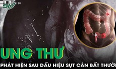 Phát hiện ung thư trực tràng sau dấu hiệu đau bụng, sụt cân bất thường