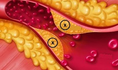 Rối loạn lipid máu nguy hiểm như thế nào?
