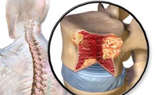 5 câu hỏi thường gặp với bệnh đa u tủy xương