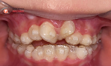 Có nên sử dụng khay trong suốt để chỉnh nha cho trẻ em?