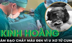 Bụng to bất thường, âm đạo chảy dịch vàng lẫn máu đen vì u xơ tử cung