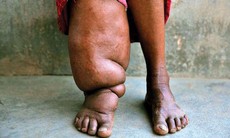 Những điều cần biết về bệnh chân voi