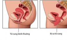 Sa sinh dục có biểu hiện như thế nào?