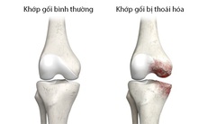 Điều trị bệnh thoái hóa khớp gối như thế nào?