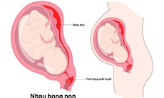 Các biện pháp xử trí, điều trị cho thai phụ bị nhau bong non