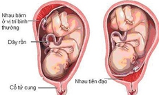 Nhau tiền đạo: Nguyên nhân, triệu chứng, cách điều trị và phòng ngừa