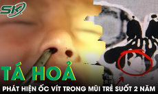 Tá hỏa phát hiện ốc vít trong mũi bé trai suốt 2 năm