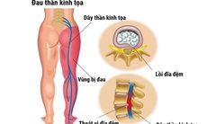 4 bài tập kéo giãn giảm đau thần kinh tọa