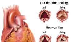 Dấu hiệu sớm bệnh tim bẩm sinh ở trẻ