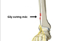 Gãy xương mác nên tập luyện như thế nào?