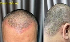 Dị ứng da đầu do thuốc nhuộm tóc