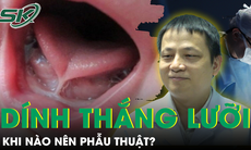 Khi nào nên phẫu thuật cắt thắng lưỡi cho trẻ?
