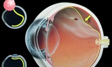 Thuốc điều trị bệnh rách võng mạc