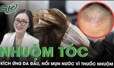 Da đầu ửng đỏ chi chít mụn nước vì dị ứng thuốc nhuộm tóc