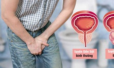 3 điều cần biết về bệnh phì đại tuyến tiền liệt