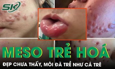 Môi trề như cá trê sau khi tiêm meso trẻ hoá 