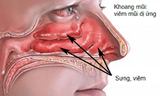 Hai vị thuốc chữa viêm mũi dị ứng tái phát khi gặp lạnh