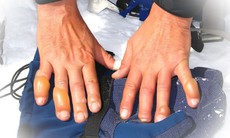 Bỏng lạnh ảnh hưởng đến sức khỏe như nào?