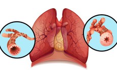 6 câu hỏi thường gặp về bệnh giãn phế quản