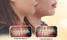Niềng răng đúng để có nụ cười khỏe mạnh, thẩm mỹ