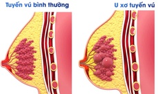 U xơ tuyến vú có dẫn đến ung thư vú không?