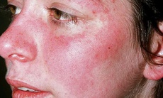 Lưu ý tập luyện cho người bệnh lupus ban đỏ