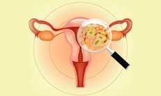 Viêm âm đạo chữa thế nào?