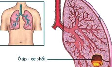 Áp xe phổi ai dễ mắc?