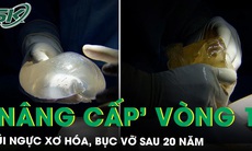 Nâng cấp vòng 1 sau 20 năm, không ngờ túi ngực xơ hóa, bục vỡ biến chứng nặng