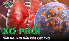 Xơ phổi - Căn nguyên dẫn đến khó thở và biến chứng nguy hiểm 
