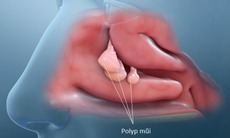 Polyp mũi: Nguyên nhân, triệu chứng, cách điều trị và phòng bệnh