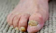 Nấm móng: Nguyên nhân, triệu chứng, lây truyền và cách điều trị