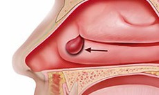 Thuốc và phương pháp điều trị polyp mũi