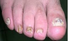 Các thuốc điều trị bệnh nấm móng