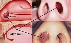 Câu hỏi thường gặp liên quan đến bệnh polyp mũi
