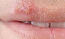 Cách phòng tránh lây nhiễm Herpes sinh dục