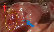 Đau bụng âm ỉ, đau bụng quanh rốn cảnh giác với viêm ruột thừa