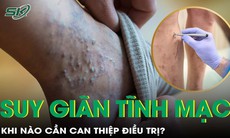 Khi nào cần can thiệp điều trị suy giãn tĩnh mạch? 