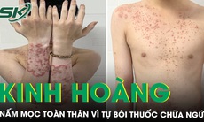 Nam sinh nấm toàn thân vì bôi thuốc chữa ngứa mua trên mạng