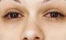 5 cách bảo vệ mắt vào mùa đông