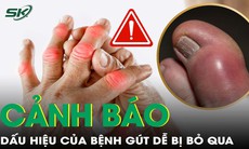 Dấu hiệu nguy hiểm cảnh báo bệnh gút dễ bị bỏ qua