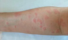 Thuốc điều trị lupus ban đỏ