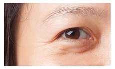 Nguyên nhân gây bọng mắt và cách khắc phục