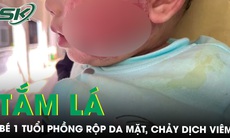Xót xa bé trai 1 tuổi phồng rộp cả mặt, chảy dịch vì tắm lá chữa viêm da cơ địa