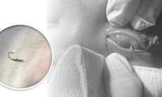 Bé trai bị lưỡi câu móc vào mắt