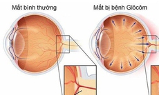 Mắt đỏ cảnh báo mắc bệnh gì, có phòng ngừa được không?