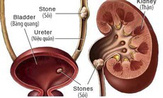 Đau hố thắt lưng kèm tiểu buốt, tiểu máu đề phòng sỏi thận, sỏi niệu quản