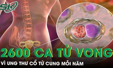 Gần 2600 ca tử vong vì ung thư cổ tử cung mỗi năm, nhận biết sớm các dấu hiệu