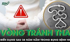 Đau bụng dữ dội do vòng tránh thai biến dạng trong bụng sau 38 năm